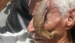 رجل يمني يعيش مع قرن شيطاني في جبينه.. صور