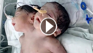 وصفها الاطباء بالمعجزة.. ولادة طفل برأسين لكنه فارق الحياة بعد ساعات