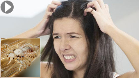 بالفيديو.. كيف ولماذا نصاب بقمل الرأس وكيف يمكن التخلص منه؟