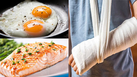 الأسماك والبيض.. 7 أغذية تساعد في التئام كسور العظام