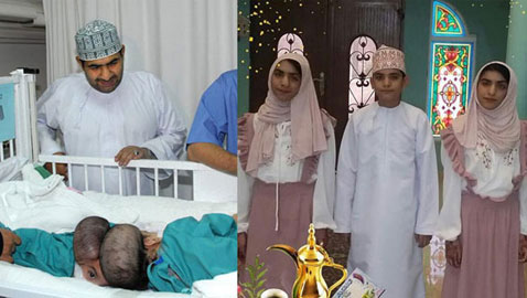 صور  التوأم السيامي العماني صفا ومروة بعد 11 عاما من عملية الفصل  بأمر ملك السعودية