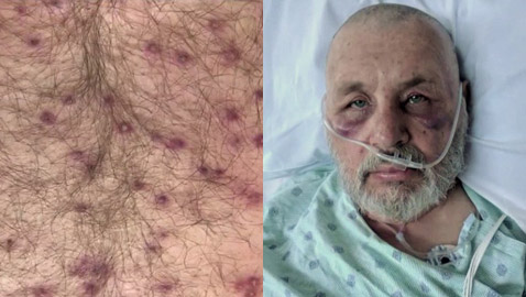رجل أمريكي ينجو من الموت بأعجوبة بعد تعرضه لأكثر من 600 لدغة من النحل القاتل