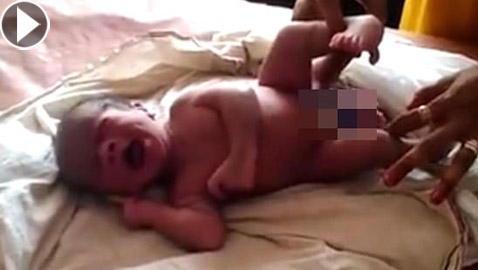 الطفل المعجزة.. ولادة طفل بأربعة أرجل وعضوين ذكريين في الهند!
