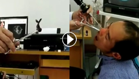فيديو صادم ومقزز.. طبيب يخرج مخلوقا حيا من أنف رجل فيتنامي!