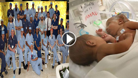 بالفيديو والصور.. نجاح أول عملية جراحية فريدة لفصل توأم ملتصق في قطر