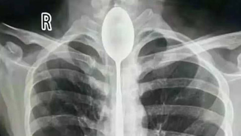 تحدٍ غريب.. رجل صيني ابتلع ملعقة ابتلعها أمام أصدقائه