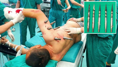 صور مرعبة: عامل مصنع يواجه الموت حين اخترقت جسمه 10 قضبان حديدية