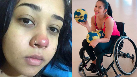 فتاة برازيلية تصاب بالشلل التام بسبب ثقب في الأنف