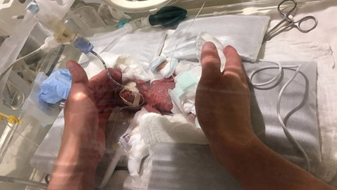 صور أصغر طفل في العالم... يخرج من المستشفى