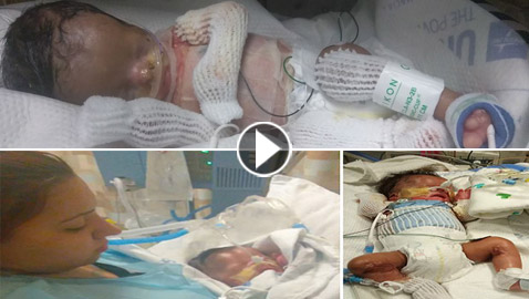 حالة طبية نادرة: طفل يولد بدون جلد يغطي جسمه!