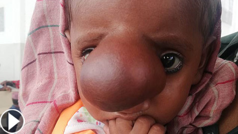 ولادة طفل باكستاني بمخ في وجهه في حالة نادرة جدا!