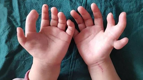 إزالة الأصابع الزائدة لطفلة صينية ولدت بـ14 إصبعا في اليدين! صور
