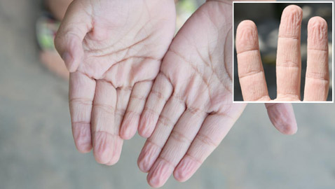ما سبب تجعد الأصابع وانكماشها عند تعرضها للماء؟
