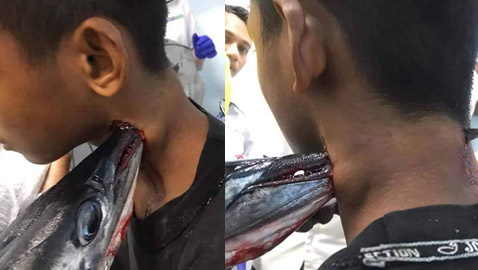 سمكة الإبرة قفزت من المياه.. واخترقت رقبة محمد