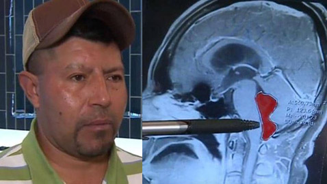 دودة في دماغ رجل لمدة 10 سنوات.. كيف دخلت وماذا فعلت بدماغه؟