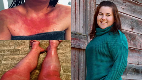 هل سمعت بمرض حساسية الماء؟ فتاة تعاني كلما استحمت أو غسلت يديها!