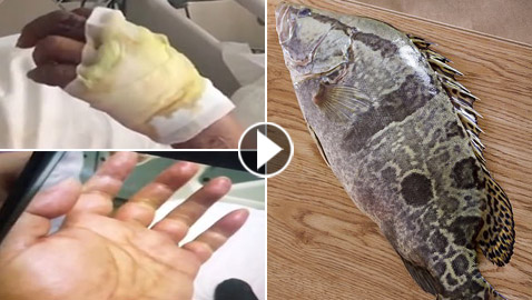 شوكة سمكة تهدد ببتر يد رجل صيني.. ماذا حدث وكيف؟