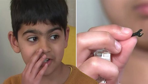 قطعة ليغو تخرج من أنف طفل بعدما ظلت عالقة في جسده لعامين! صور