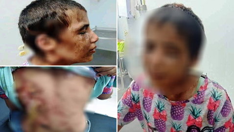 صور موجعة: أسرة تعذب طفلة بطريقة وحشية أثناء خدمتها لهم في الجيزة!