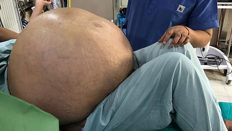 استئصال أكبر ورم مبيض في العالم.. والطبيب: لم أرى شيئا مثله بحياتي!