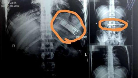 في وصلة مزاح.. شاب يبتلع هاتفا محمولا منذ 7 أشهر!