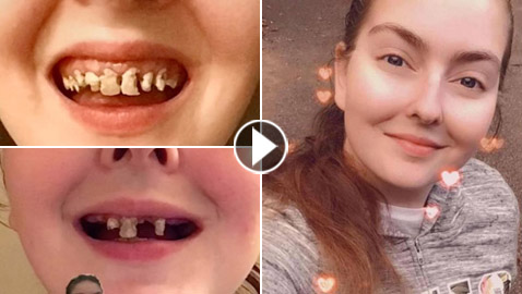 فقدت أسنانها! صور صادمة لسيدة أدمنت المشروبات الغازية طيلة 9 سنوات